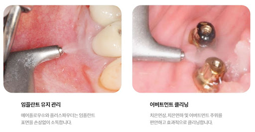 천안 치아교정, 서울비디치과 불당본점에서는 합리적인 가격으로 진행됩니다